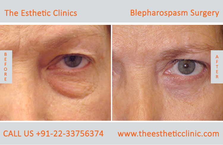 Blepharospasm Treatment, Eyelid Treatment before after photos in mumbai india (5)